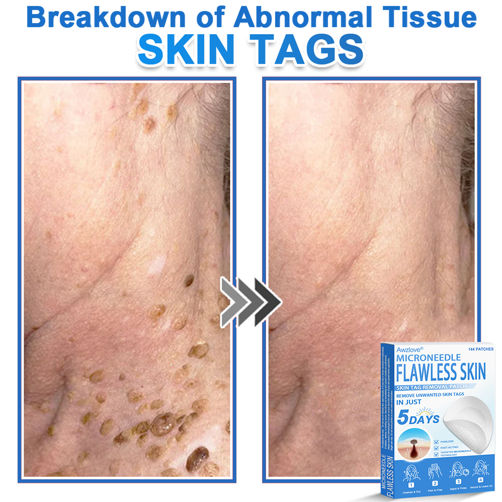 📌 Awzlove® 2-in-1 Microneedle & Hydrocolloid Patch | Raised Moles,Acne,  Flat Warts & Skin Tags Remover | Improves Wrinkles, Scars & Blemishes | Invisible Star Pimple Patches for Face & Body |🎁🎁