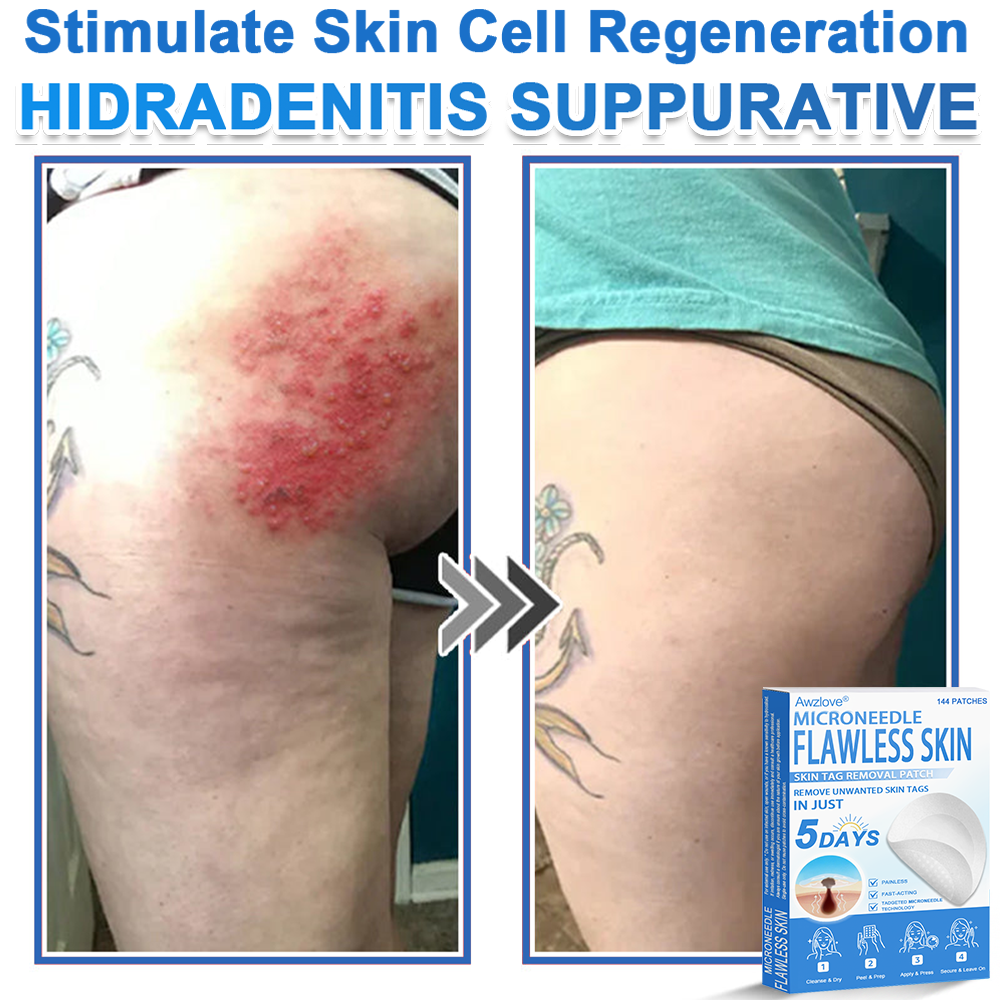 📌 Awzlove® 2-in-1 Microneedle & Hydrocolloid Patch | Raised Moles,Acne,  Flat Warts & Skin Tags Remover | Improves Wrinkles, Scars & Blemishes | Invisible Star Pimple Patches for Face & Body |🎁🎁
