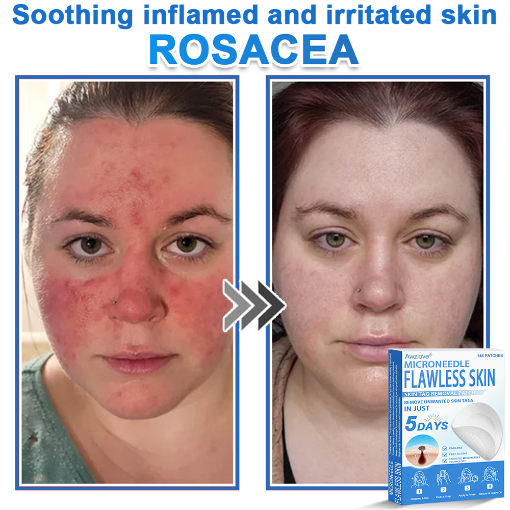 📌 Awzlove® 2-in-1 Microneedle & Hydrocolloid Patch | Raised Moles,Acne,  Flat Warts & Skin Tags Remover | Improves Wrinkles, Scars & Blemishes | Invisible Star Pimple Patches for Face & Body |🎁🎁