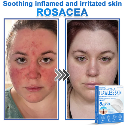📌 Awzlove® 2-in-1 Microneedle & Hydrocolloid Patch | Raised Moles,Acne,  Flat Warts & Skin Tags Remover | Improves Wrinkles, Scars & Blemishes | Invisible Star Pimple Patches for Face & Body |🎁🎁