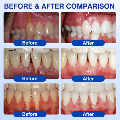 Healrize® GumRevive Periodontal Repair Gel (for bleeding gums, receding gums, and loose teeth)🥰☀️