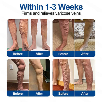 🇬🇧👨‍⚕️👍✅Healrize® VeinTarget Microneedle Patch⚡Instant Relief, Long-Term Results🍉❤️