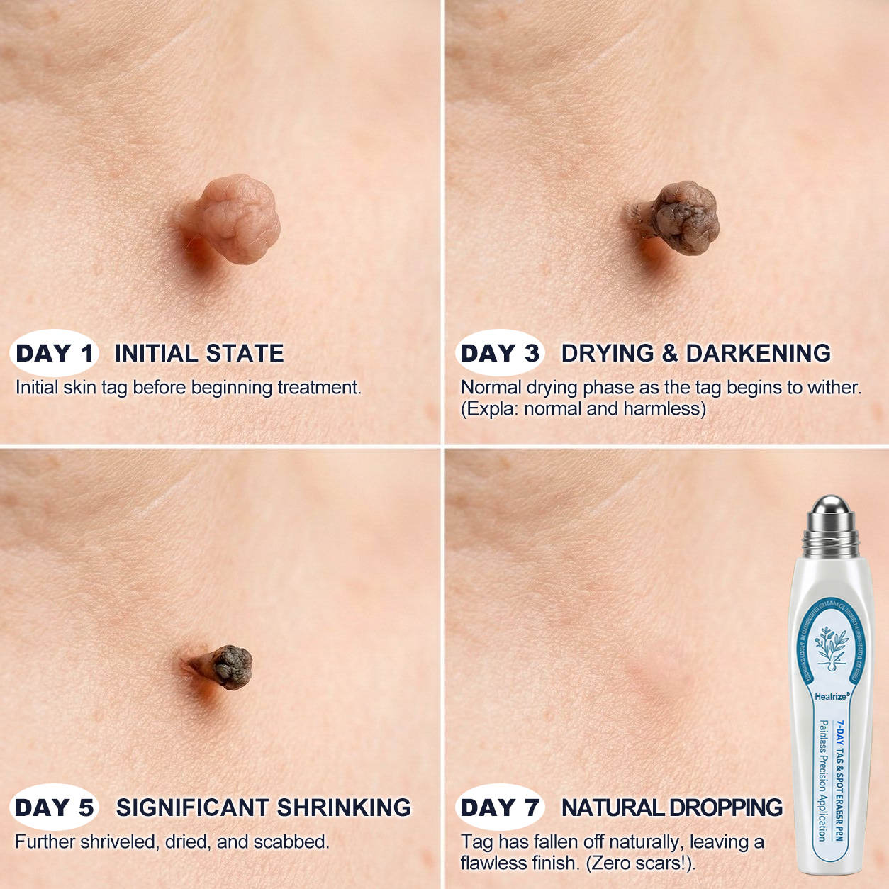 𝐇e𝐚𝐥𝐫i𝐳e® 7-𝐷𝑎𝑦 𝗧𝐚𝐠 & 𝗦𝗽𝐨𝐭 𝐄𝐫𝒂𝒔𝒆𝒓(Zero Pain, Zero 𝐒𝐜𝐚𝒓𝒔 Rollerball)💪